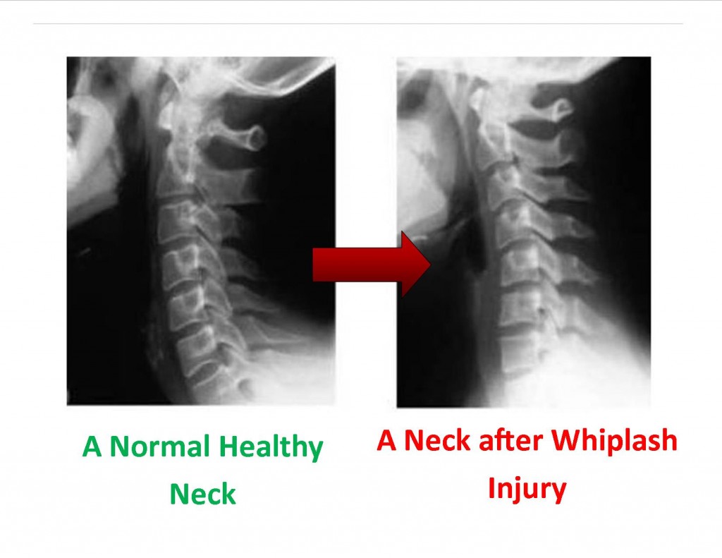 Whiplash Injuries Aloha Beaverton Se Portland Or Chiropractor